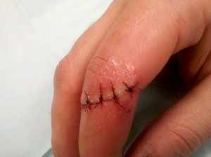 stitches ouchy culinary finger dumb numb